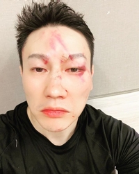 H유진, TKO 패배.. 피멍 얼굴 공개 “추성훈 형님께 죄송”