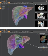 ‘의료계 AI 훈풍’ 삼성서울병원, 간이식 AI 모델 개발 “일본 주도 시장 깬다”