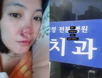 고은아, 낙상사고 안면 부상 후 근황...“내 앞니 우짜노”