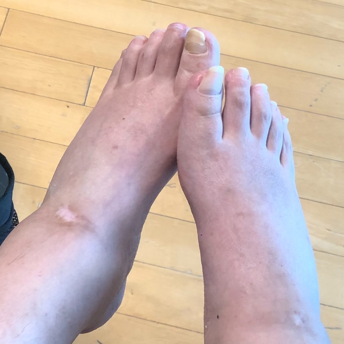 호전된 강원래의 발 상태. 김송 SNS.