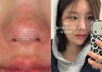 ‘워터밤 여신’ 권은비, 얼굴에 2도 화상...킬리만자로가 화근이었다