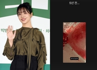 “코피가 안 멈춰” 차주영, 1시간 넘긴 출혈 영상 공개