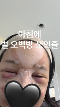 랄랄, 성형 수술 파격 근황 공개...“벌 500방 쏘인 줄”