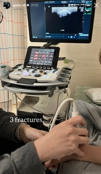 ‘이럴수가’ 스노보드 ‘역전 우승’ 최가온, 부러진 뼈로 금메달 땄나 “3곳 골절”[2026 밀라노]