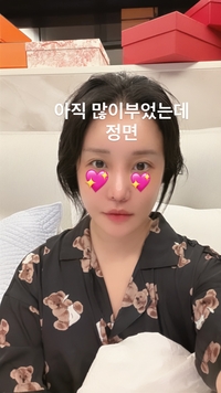 랄랄, 눈밑지·코 성형 6일 차 확 바뀐 정면 얼굴까지 쿨하게 공개