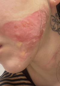 “미친X 맞죠?” 권민아, 화상 입힌 피부과 대처에 분노