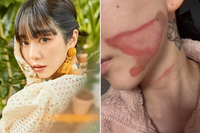 ‘얼굴 화상’ 권민아, 의료사고 이후 도움 요청…“피부 돌아왔으면”