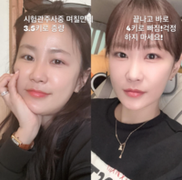 “살벌하게 부었다” 김지민, 시험관 시술 후 3.5kg 급증… 충격적인 몸의 변화