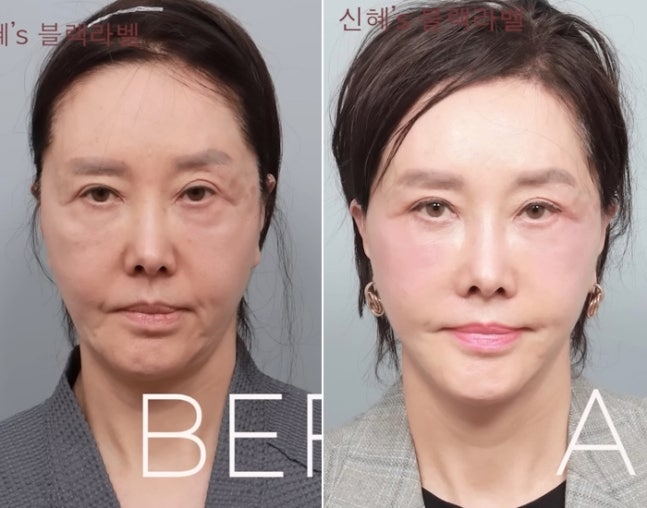 유혜리 “심하게 당겨달라 했다”…62세 배우의 ‘솔직’ 안면거상