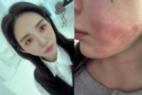 ‘슈링크 화상 피해’ 권민아, 의료사고에 협박 논란까지 “회복 더뎌 두렵다”