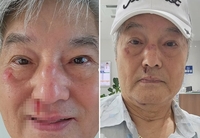 “폭행당했나” 56년 봉사천사 한지일, 얼굴 피범벅...걱정 폭주