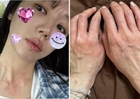 “숨도 안 쉬어져” 윤은혜, 심상찮은 건강 이상 고백…온몸 알레르기까지