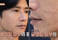 “식도 녹고 온몸 수포” 오종혁, 간수치 800까지…달라진 피부에 충격