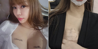 ‘나솔’ 10기 정숙, 가슴 문신 7번째 제거 시술...“너무 아프지만 연해져서 위로”