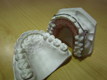 치아모형틀에 유지장치 장착한 모습