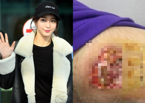 [SS초점] '의료사고' 한예슬, 추가로 흉터 사진 공개…소속사, 묵묵부답