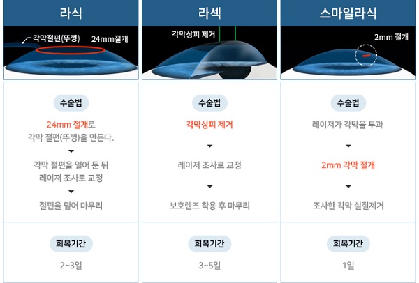 스마일라식과 라식,라섹, 스마일라식과 라식,라섹,