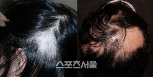 원형탈모 환자, 심근경색 위험 최대 4.5배