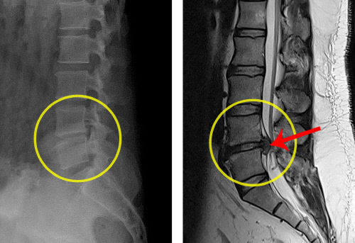 [힘찬병원] 허리디스크 환자의 엑스레이와 MRI(오른쪽)검사결과