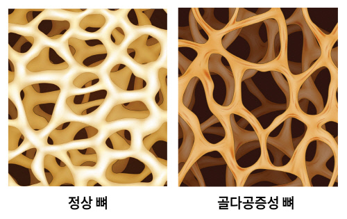 골다공증성 뼈 이미지_출처 게티이미지뱅크