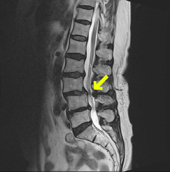 [힘찬병원 자료사진] 척추 전방 전위증