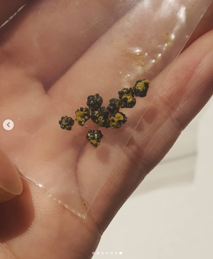 안소미 "초코칩같은 OO이 9개" 후덜덜한 담낭제거수술 후기[★SNS]