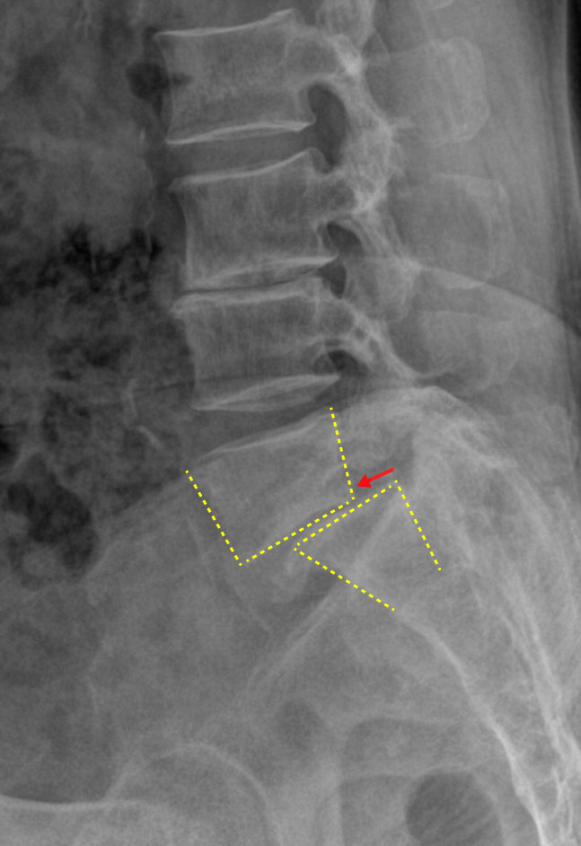 척추전방전위증 엑스레이