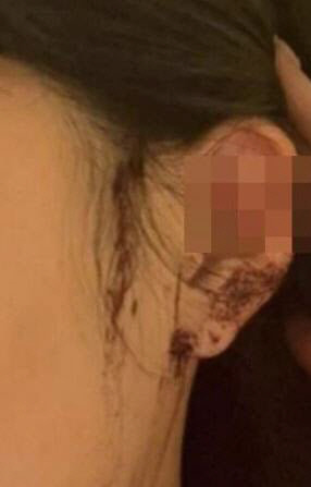 강남 클럽서 20대 여성 귀잘리는 엽기범행 "술 깨보니 귀 잘려 있었다"