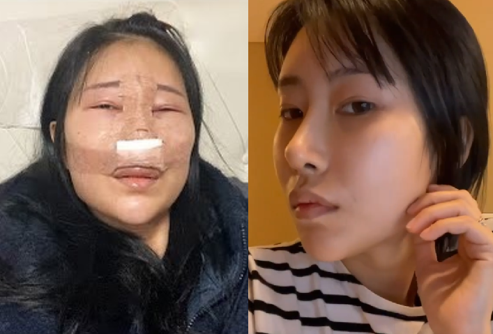 이세영, 코 성형수술 만족 "볼수록 신기하네"