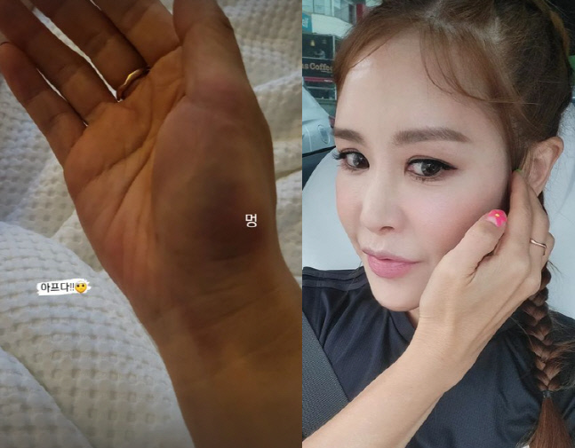 채리나, 손목 가득 시퍼런 멍..무슨 일?