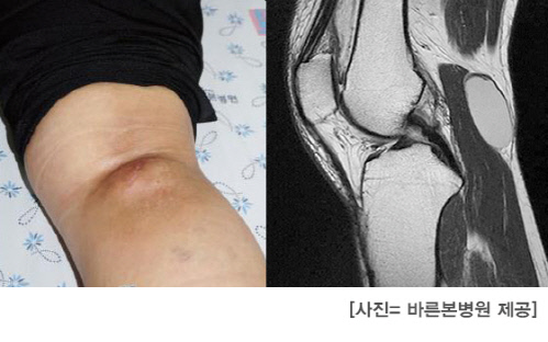 바른본병원_관절염도_속상한데_무릎_뒤에_~